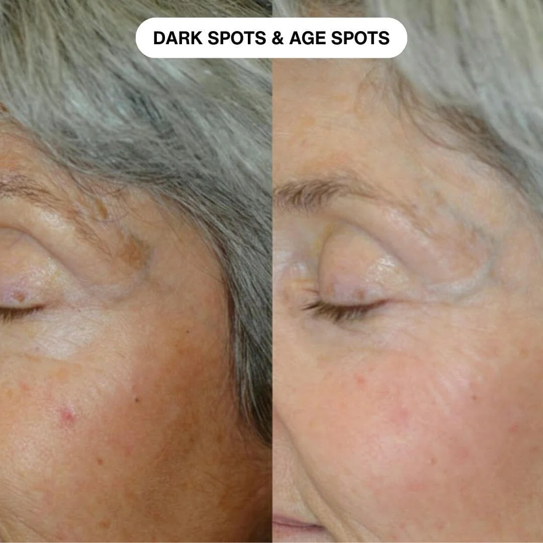 Ryte Micro-Infusion System - Image 11