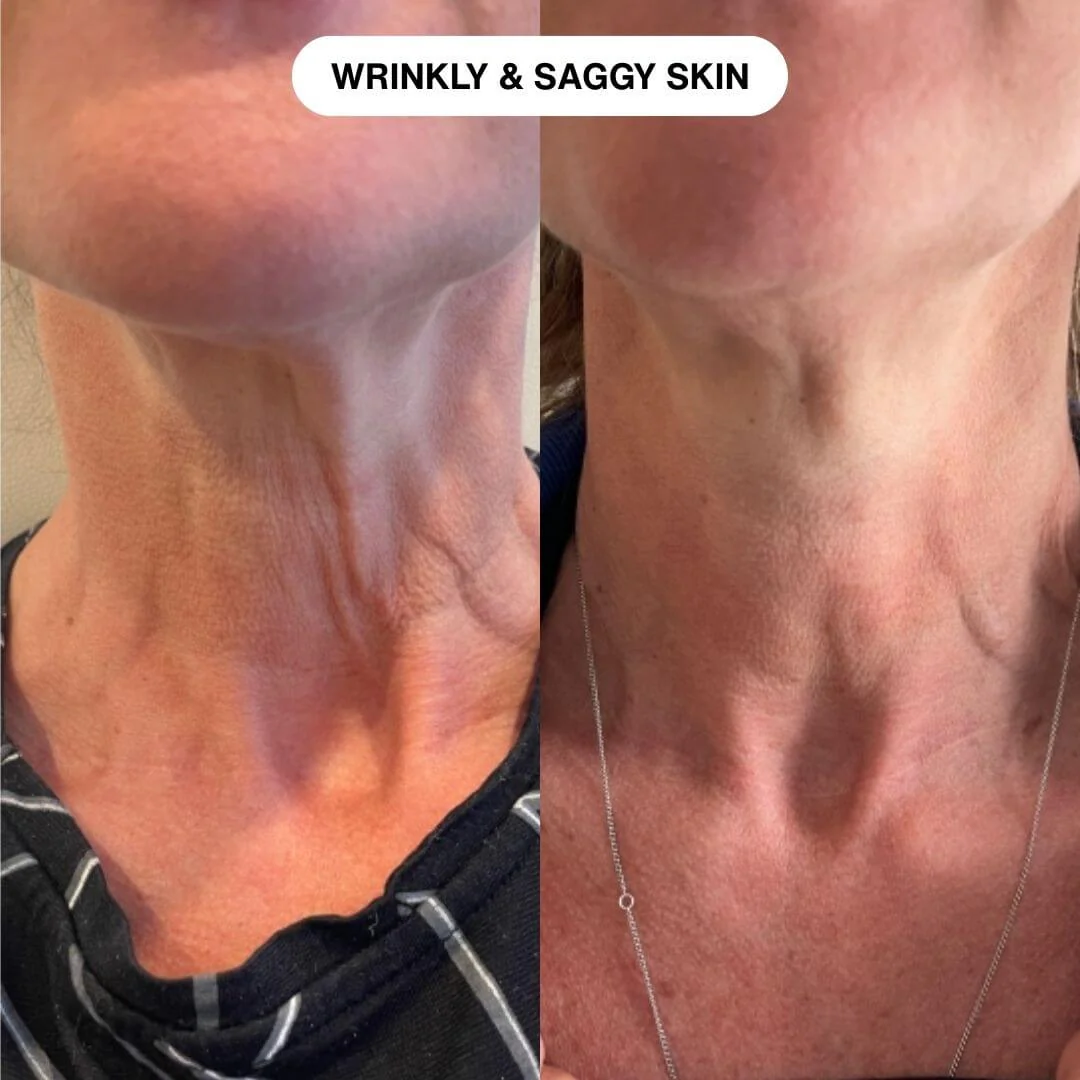 Ryte Micro-Infusion System - Image 4