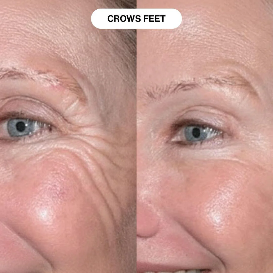 Ryte Micro-Infusion System - Image 10